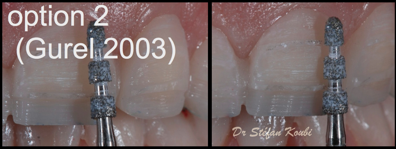 veneers and crowns /Dr Stefan Koubi